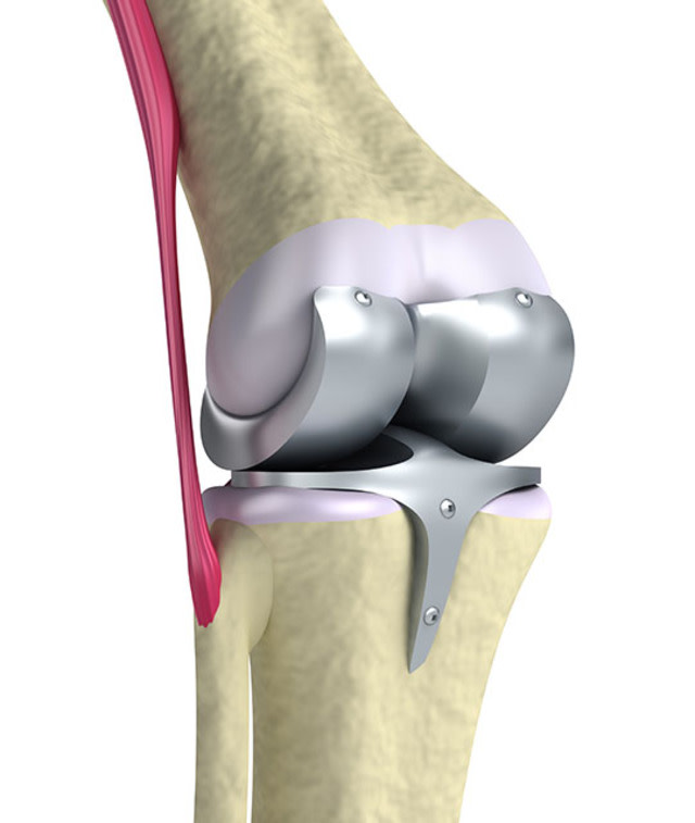 Remplacement total des articulations